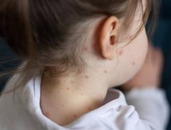 Innalilahi, Dua Balita di Pamekasan Meninggal Dunia Akibat Penyakit Campak